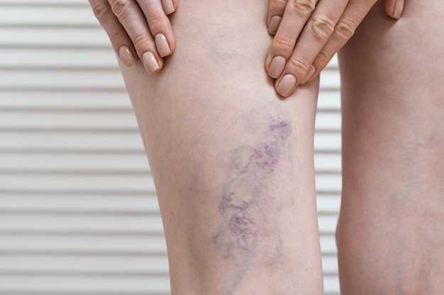Методы лечения герпеса на ногах