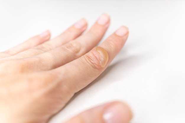 Повреждение ногтей при маникюре