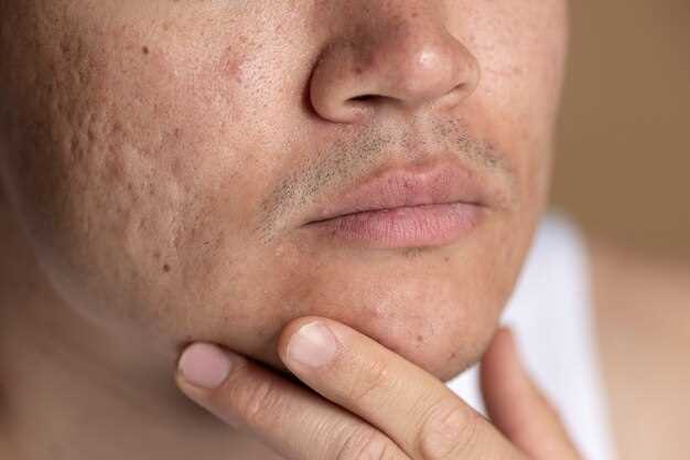 Домашние средства для снятия симптомов псориаза на лице